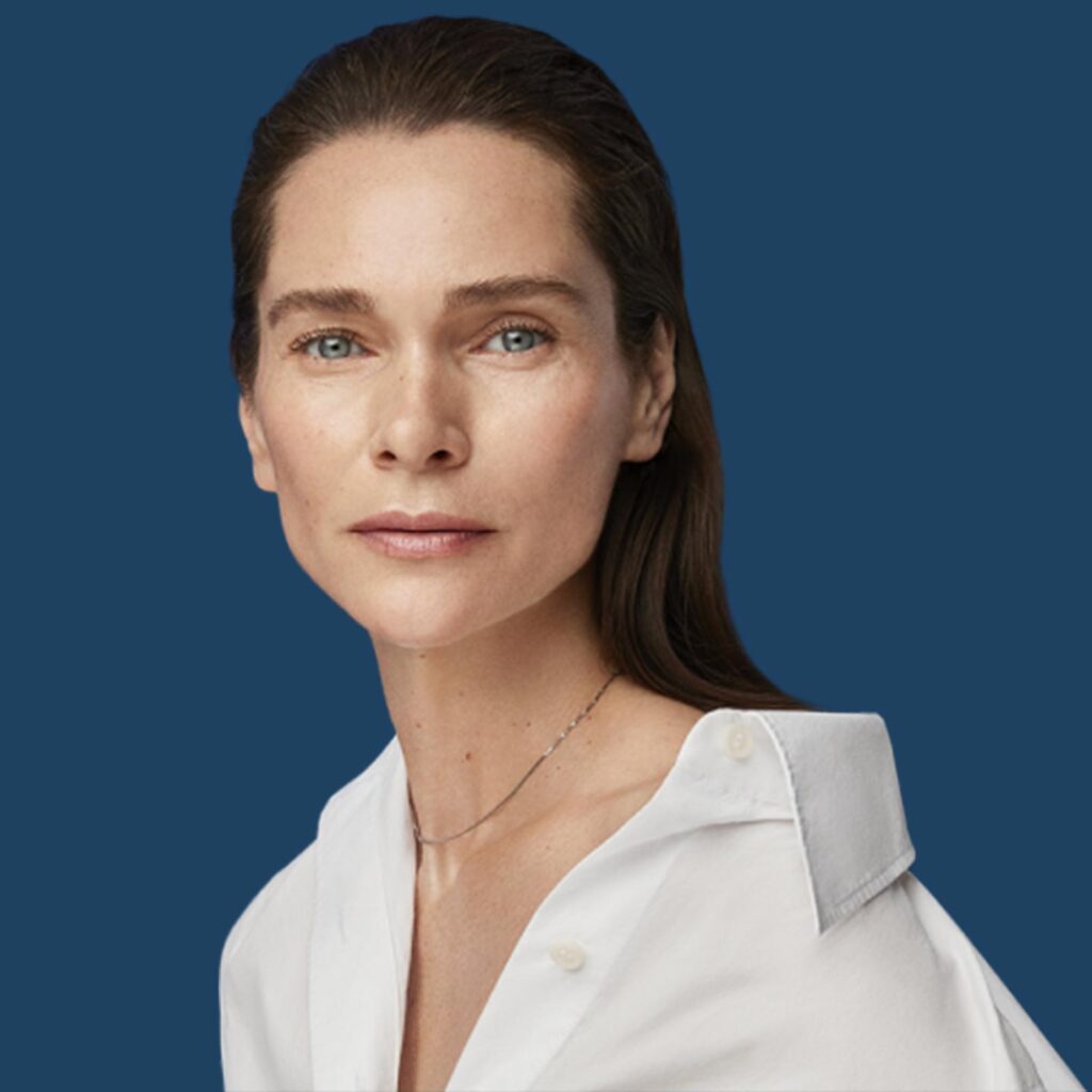 Radiesse behandeling 1