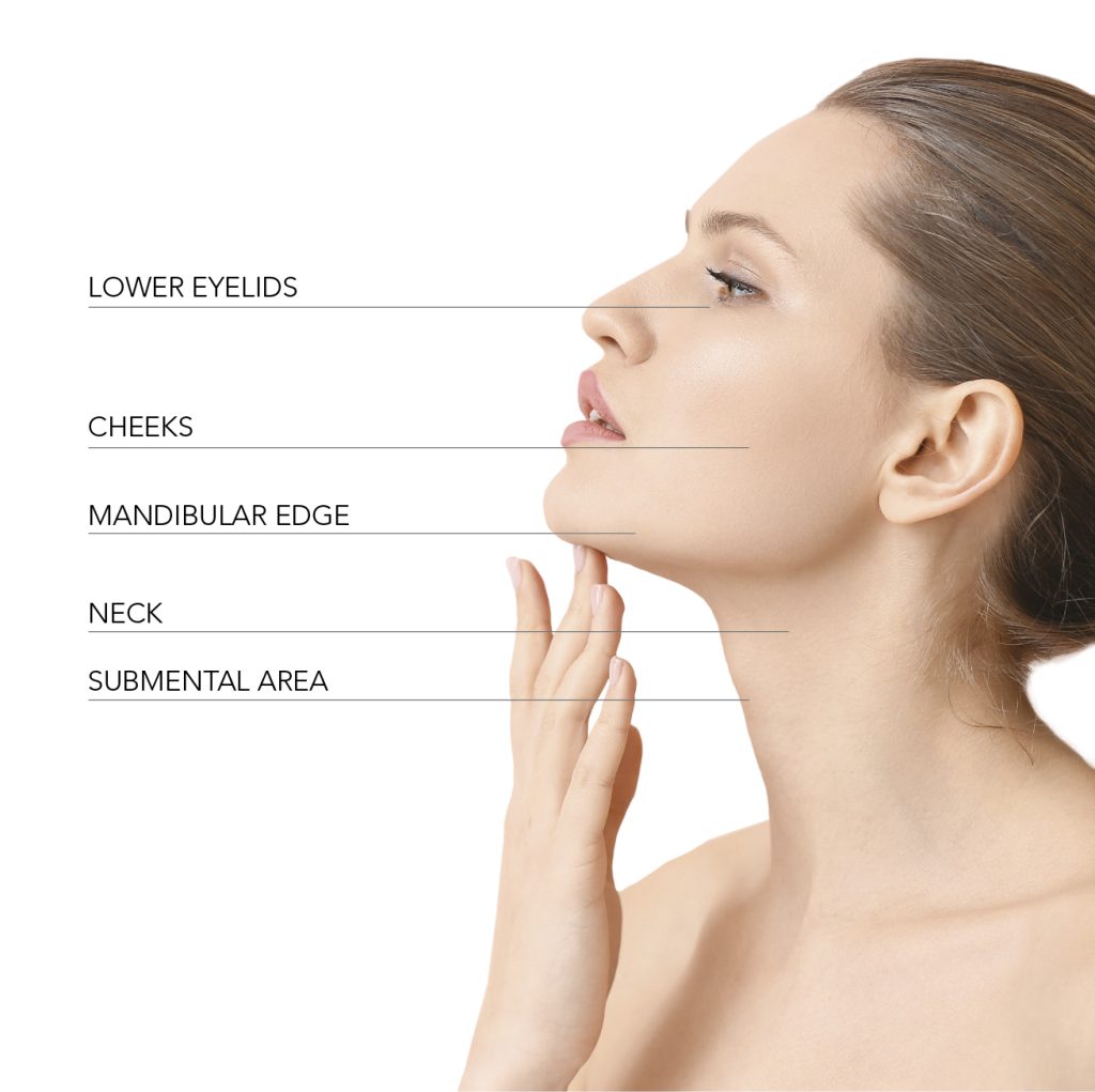 Endolift