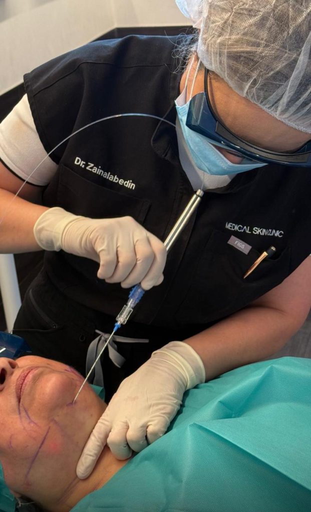 Lipolaser behandling