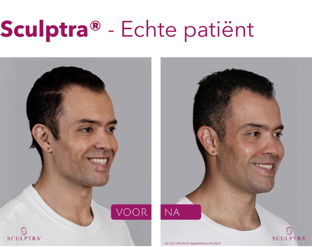 sculptra voorna
